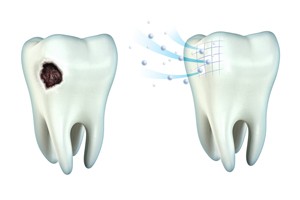 Tooth cavity and remineralization