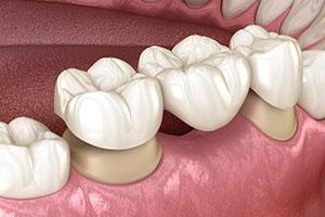 Dental Bridge