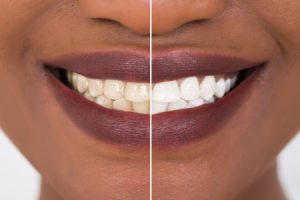 Before & After Teeth Whitening