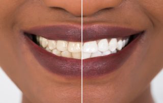 Before & After Teeth Whitening