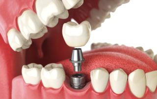 Dental Implant Illustration