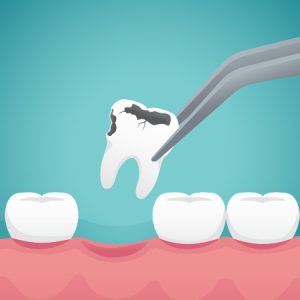 Tooth Extraction & Dry Socket