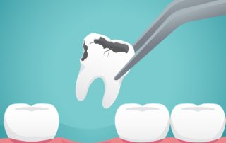 Tooth Extraction & Dry Socket