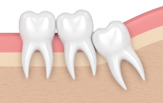 Wisdom Teeth Crowding