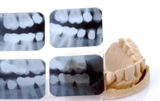 Full Mouth Dental X-Rays