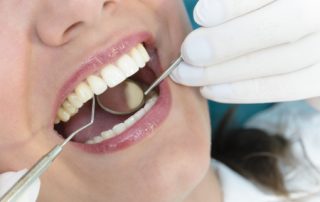 Periodontal Maintenance Checkup