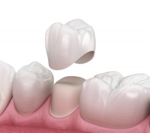 Placement of a Premolar Dental Crown