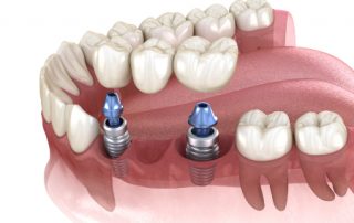 Restoration with Dental Implants