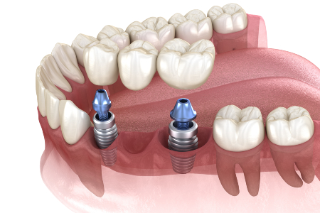 Restoration with Dental Implants